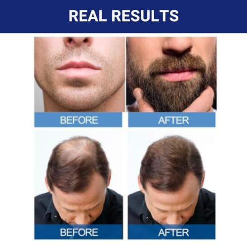 Kirkland Minoxidil 5% Extra Strength Men Hair Regrowth Solution 3 Month 