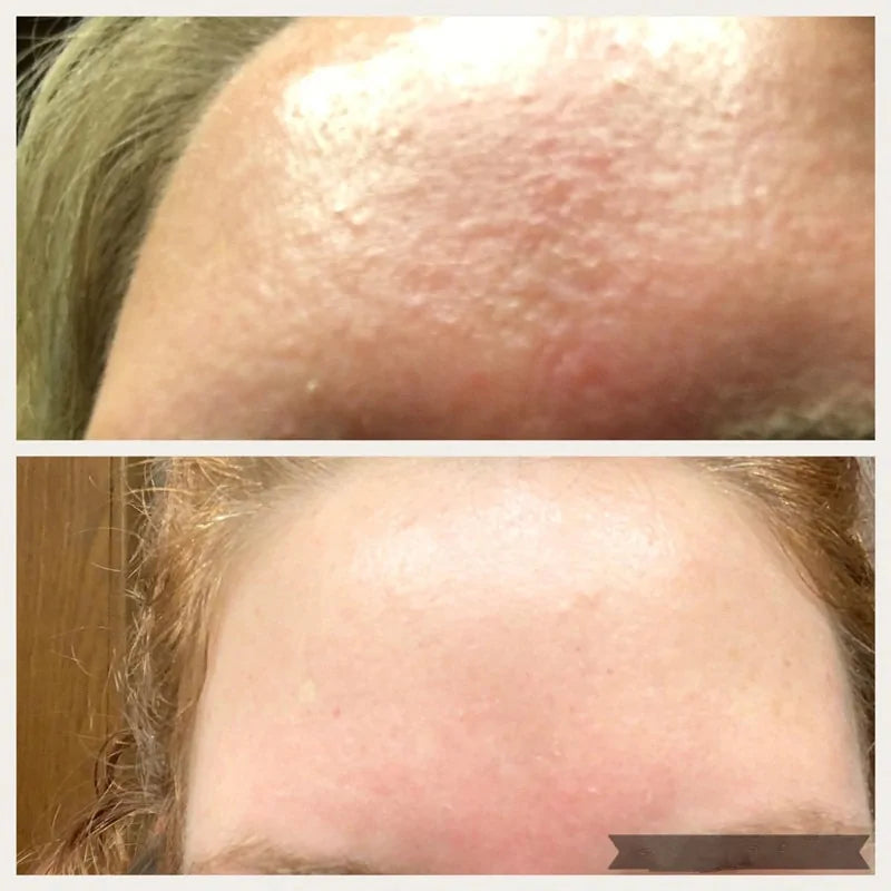 AHA 30% + BHA 2% Peeling Solution