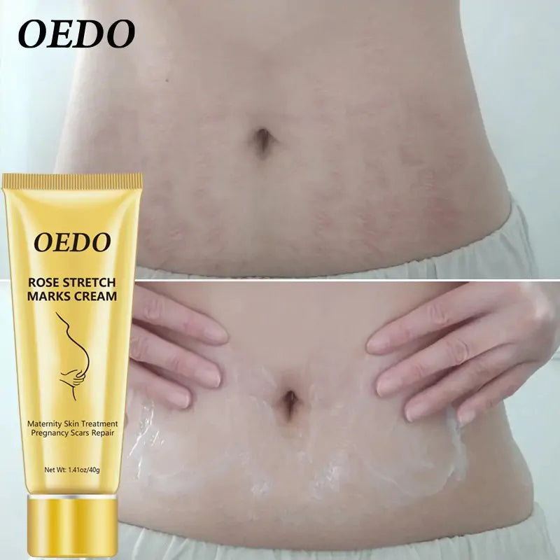 OEDO Stretch Mark Cream